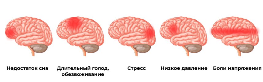 интенсивность головной боли